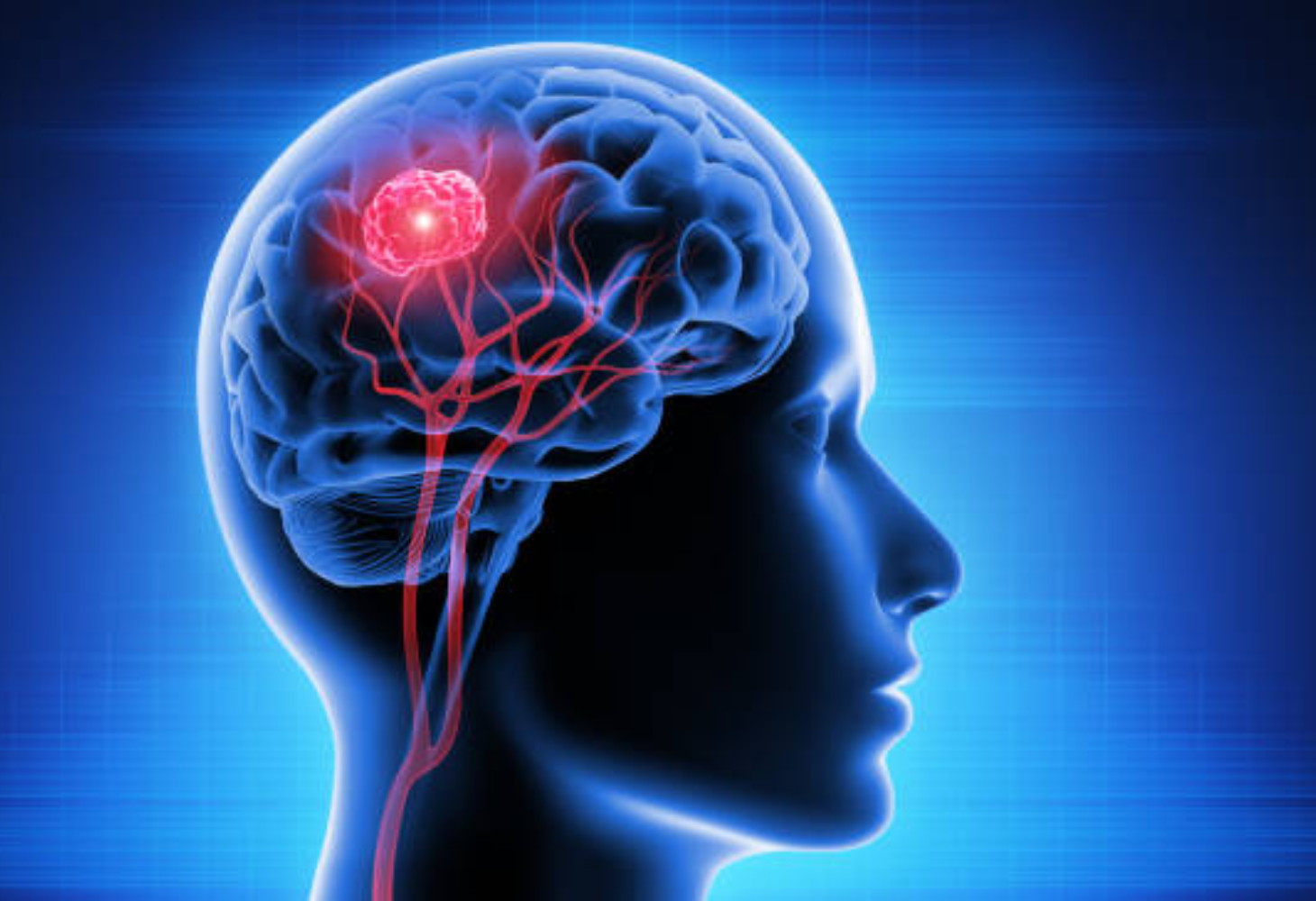 World Brain Tumor Day: ભારતમાં ઝડપથી વધી રહ્યુ છે બ્રેઈન ટ્યુમરનું રિસ્ક