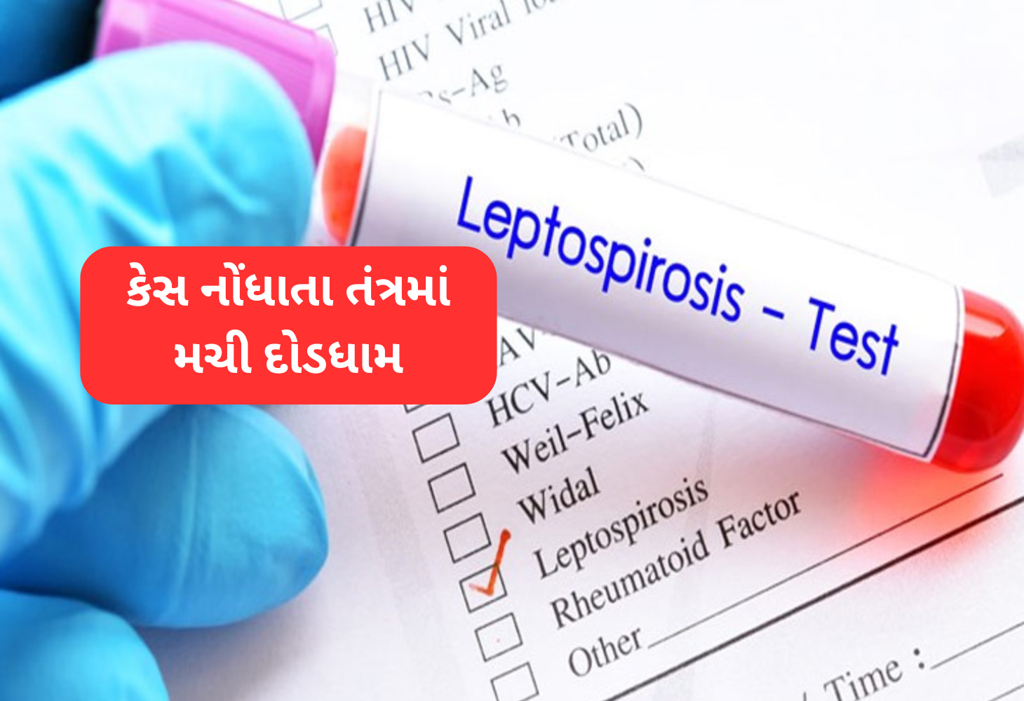 Surat લેપ્ટોસ્પાયરોસિસનો પ્રથમ કેસ નોંધાયો, આરોગ્ય તંત્ર એલર્ટ